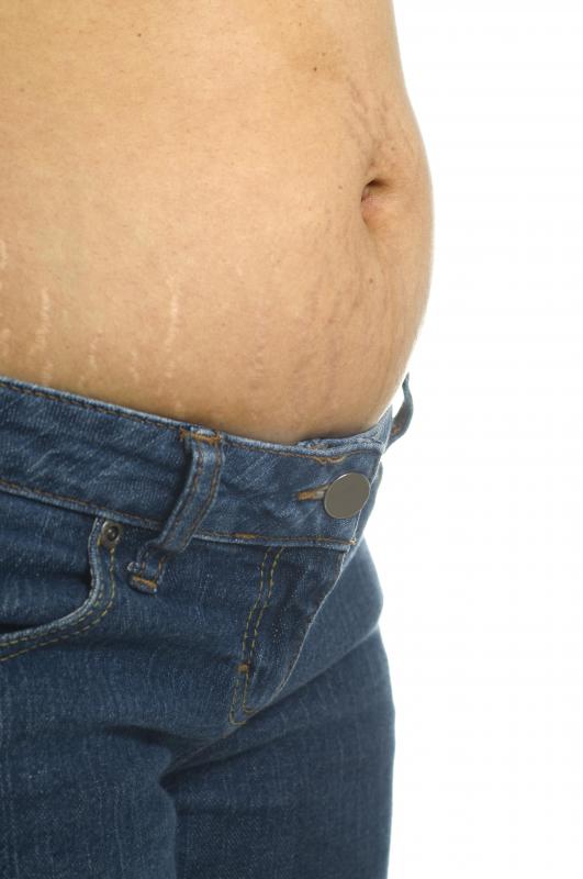 Stretch Mark Lasering