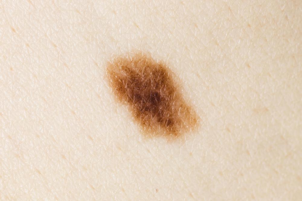 Dark Patch Skin Moles