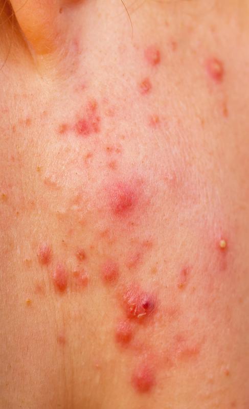 Boils Causes, Treatments, Prevention, & More - WebMD