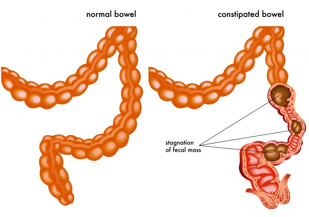 How do you clear laxative tea side effects from your body?