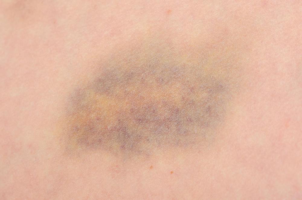 Dark Spots That Look Like Bruises