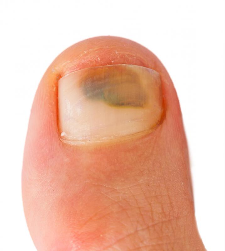 Ingrown toenail removal surgery infection   tdhurst