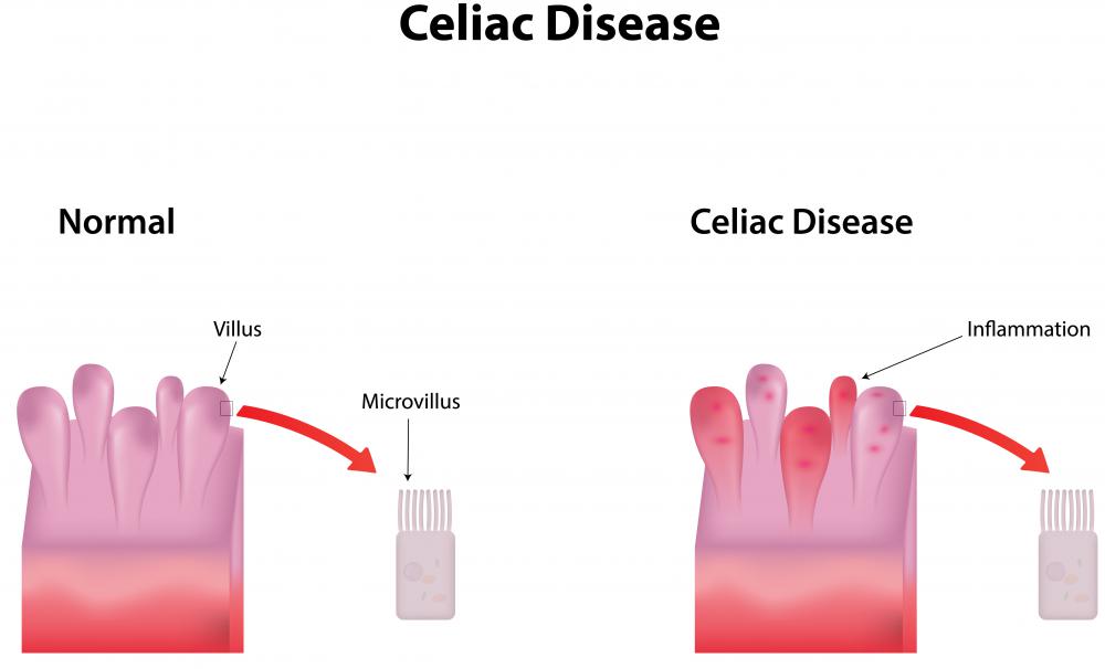 Celiac And Lactose Intolerance Diets For Quick