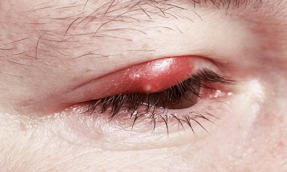 Sty (Stye) Treatment, Home Remedies & Pictures