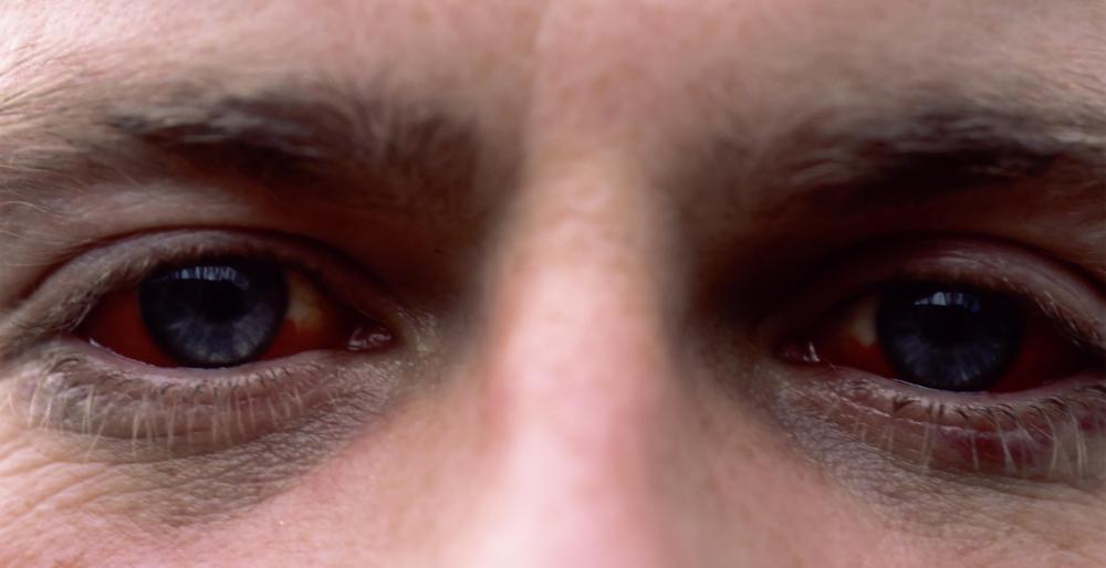 Prolonged use of artificial tears or eye drops that contain tetrahydrozoline hydrochloride can cause red eyes.