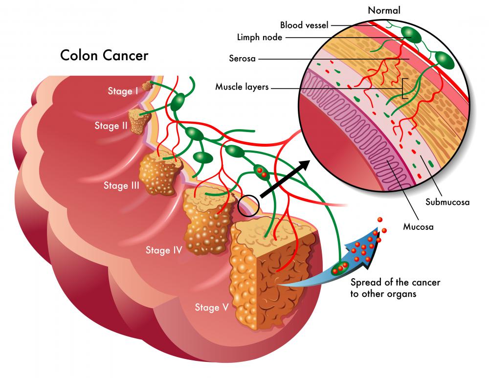 How are benign stomach tumors and polyps detected?