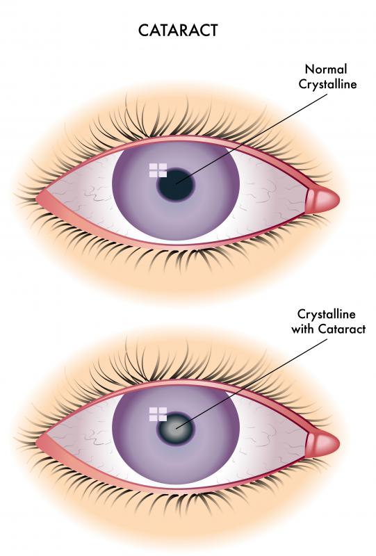 What are some complications that can happen from cataract surgery?