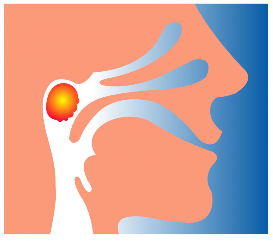 Adenoid Mass