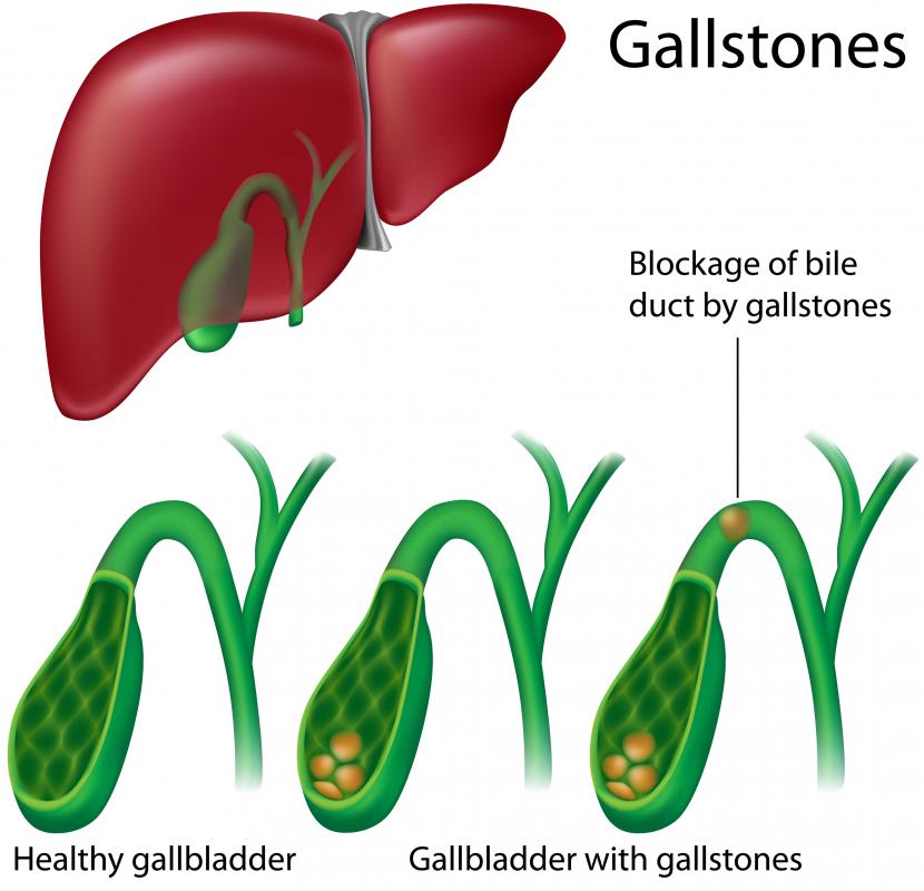 What Are The Side Effects Of Someone Having Their Gallbladder Removed