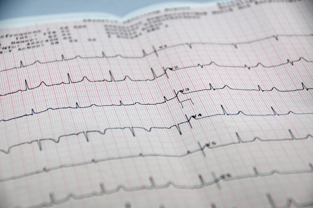 A resting ECG provides a baseline measurement to use for comparison with measurements taken during exercise.