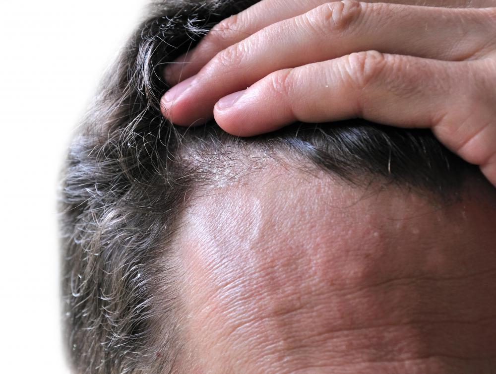 What Causes Scalp Scabs with Pictures 