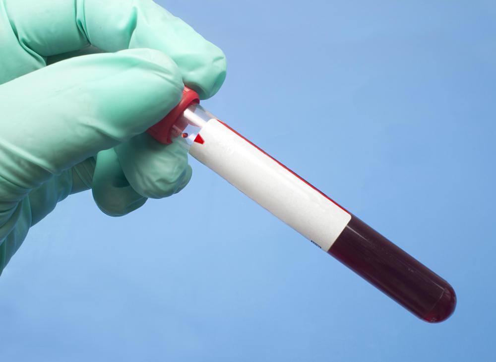 A blood panel may be conducted to determine the cause of a colon stricture.