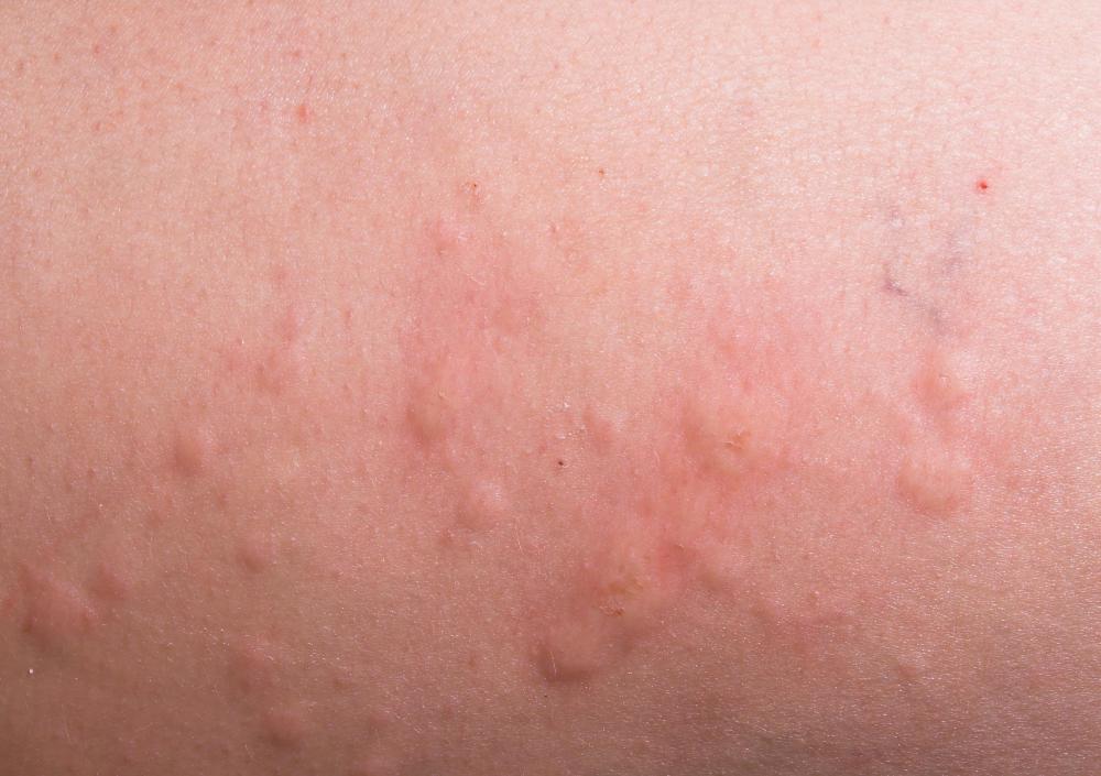 What are Welts? (with pictures)