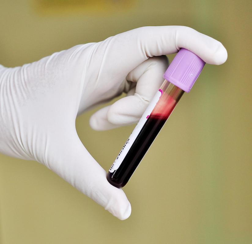 Blood tests may be performed to diagnose retroperitoneal sarcoma.