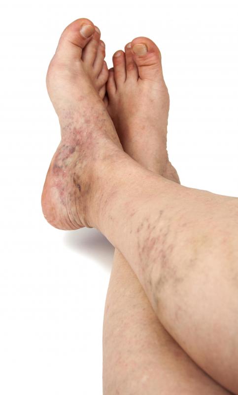 Shimmer bronzer may be used to cover spider veins.