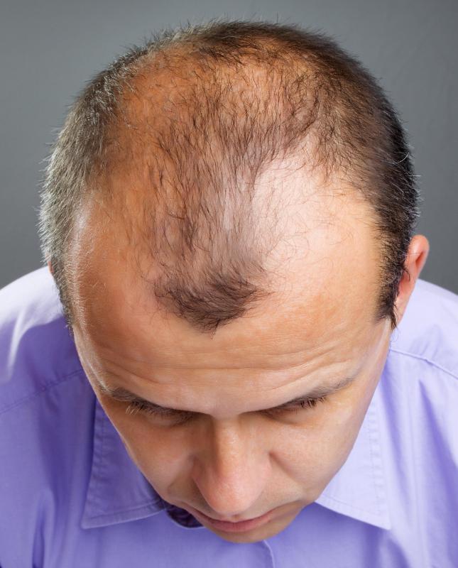 What Causes Thinning Hair In Men With Pictures