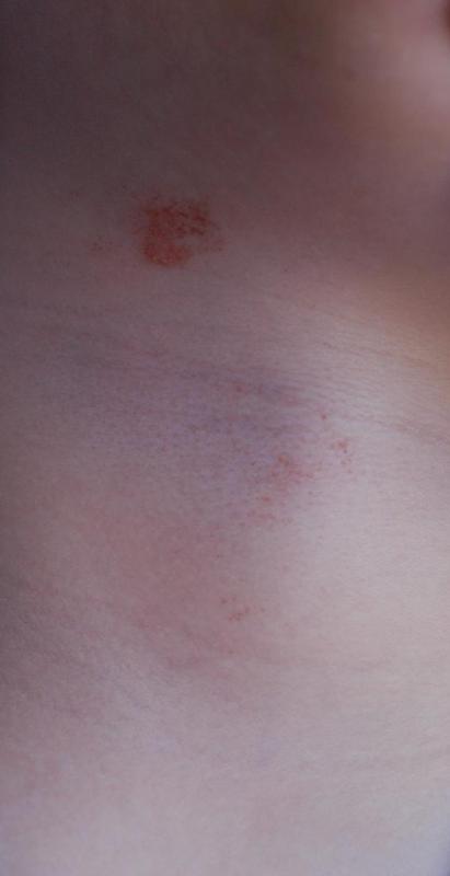 Victims of strangulation often develop small red marks known as petechiae, caused by burst capillaries.