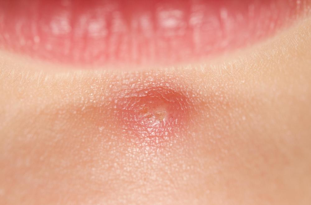 Bumps on the Skin: Check Your Symptoms and Signs