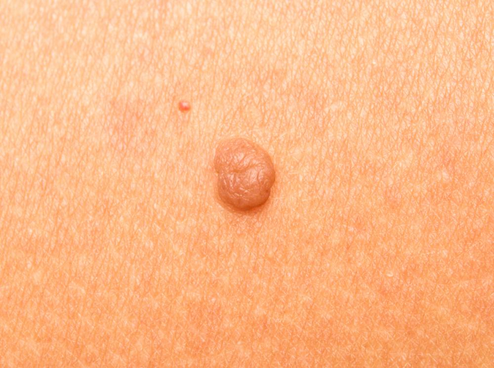 skin mole picture