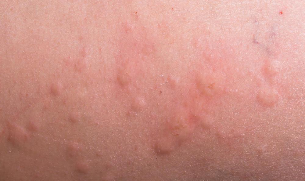 red-bumps-on-skin.jpg