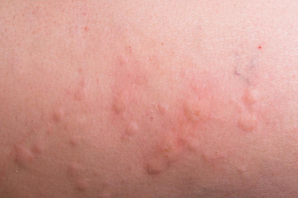 What Are Hives? (with pictures)