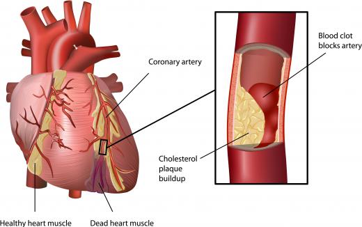 A thrombus in the heart can kill part of the heart muscle.
