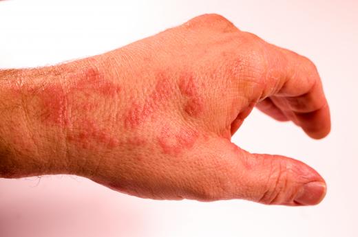 A maculopapular rash can stem from an allergic reaction to a medication or food.