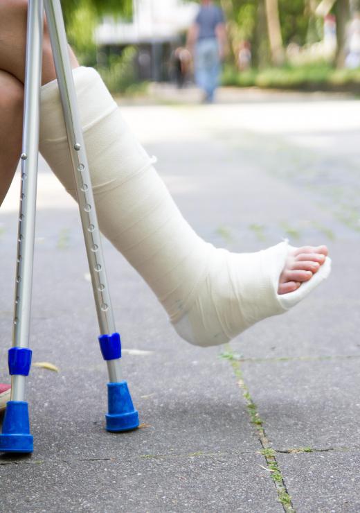 For older patients, a cast may be worn to support the ankle while the calcaneofibular ligament heals.