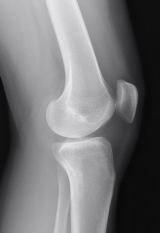 In this side view knee x-ray, the tuberosity is the ridge at the top of the tibia (lower bone).