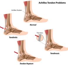 A diagram of the Achilles tendon and common tendon problems. 