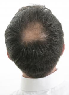 A man with a bald spot