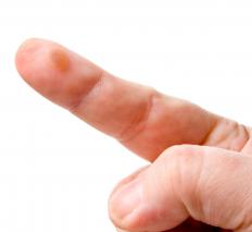 A herpetic whitlow
