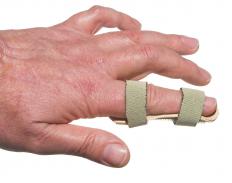 A badly bruised finger may be set in a splint to prevent movement while it heals.