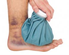 A man with a sprained ankle.