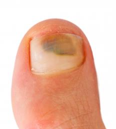 A person with a bruised toenail from running.
