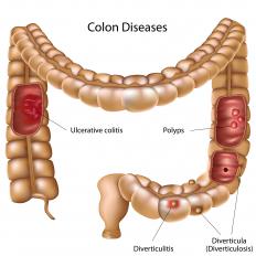 A diagram showing sigmoid polyps and other colon problems.