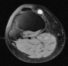 A cross-section of a ganglion cyst, which can cause thumb numbness.
