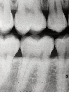 Dental X-ray