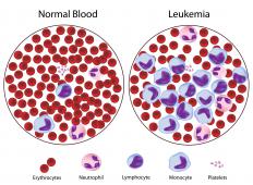 A diagram of normal blood and blood from someone with leukemia.