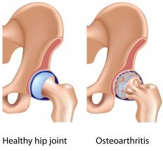 A healthy hip and one with osteoarthritis.