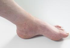 A person with itchy swollen feet.