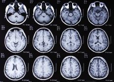 An MRI scan of the brain may be used to help diagnose brain herniation.
