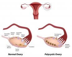 A diagram of a healthy ovary and one with cysts, which a gynecologist can help with.