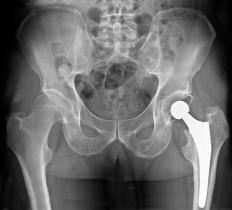 Some people develop osteolysis after hip replacement surgery.