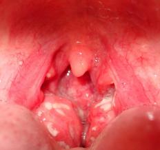 A person with inflamed tonsils
