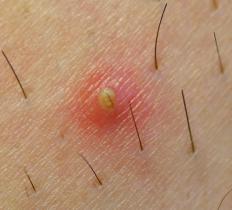 An ingrown hair with yellow pus.