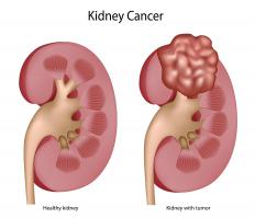 An example of a healthy kidney and one with cancer, which can cause frequent urination and fatigue.