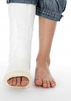 A person with a comminuted fracture.