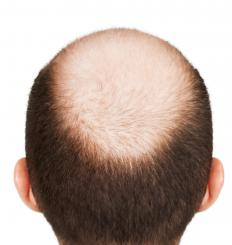 A man with male pattern baldness.
