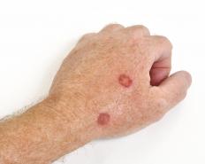 A man with precancerous skin lesions.
